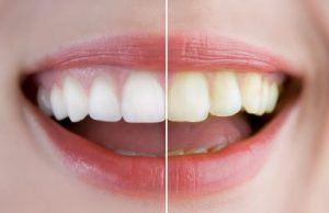 teeth whitening in st brelade jersey